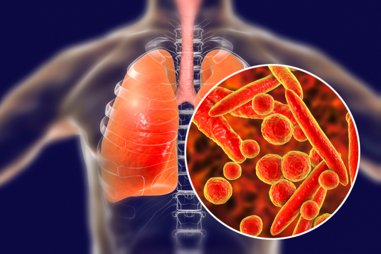 hậu quả của bệnh lao phổi