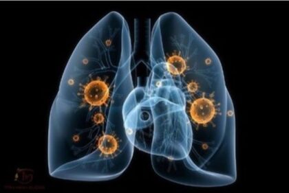 Những thắc mắc và nhìn nhận chưa đúng về bệnh lao phổi