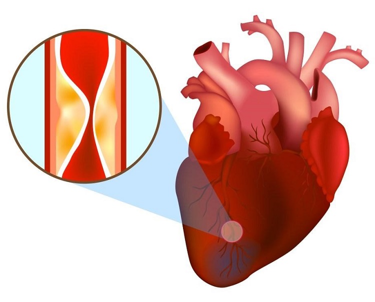 Hối hận vì xem thường nhồi máu cơ tim cấp