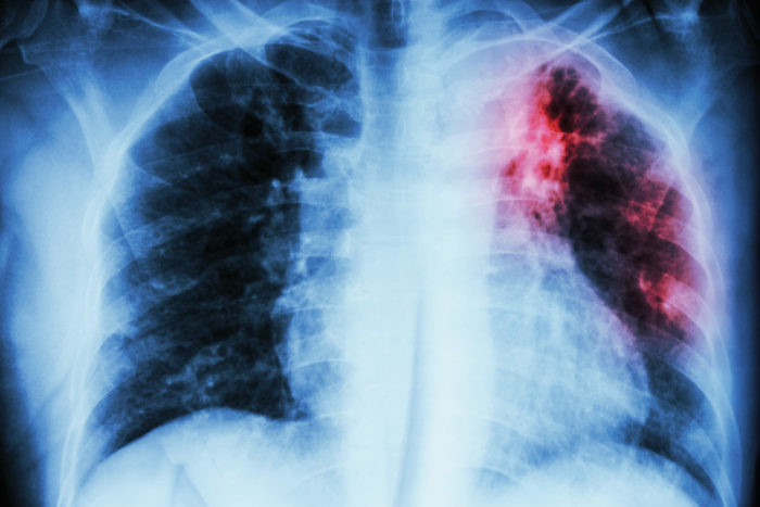 bệnh lao phổi là gì