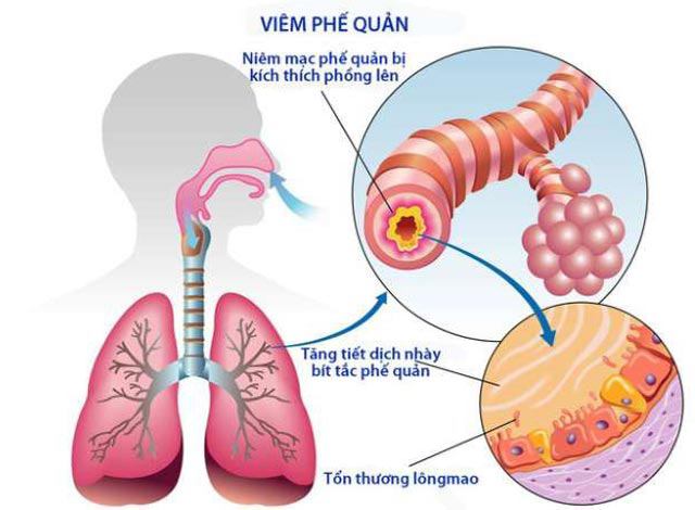 Các mẹ không nên chủ quan : viêm phế quản ở trẻ em