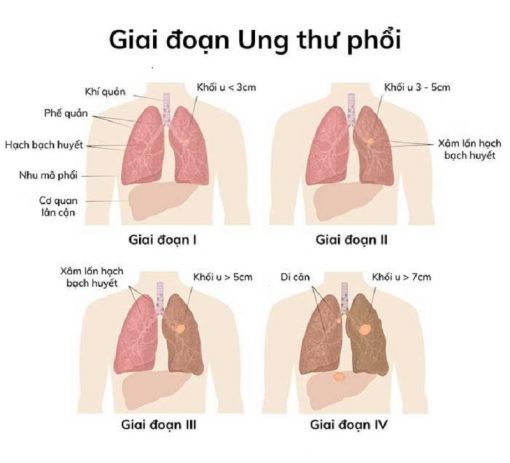 Các giai đoạn của ung thư phổi