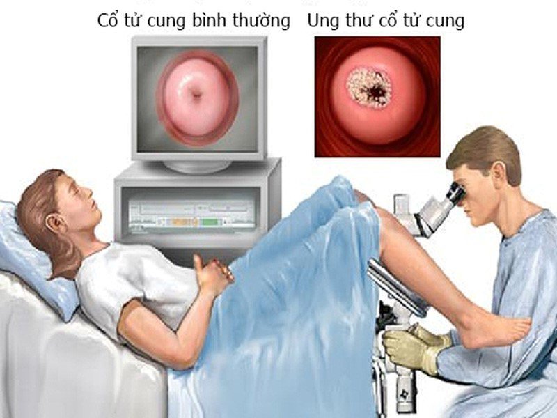 ung thư cổ tử cung là gì