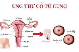 ung thư cổ tử cung