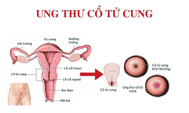 bệnh ung thư cổ tử cung