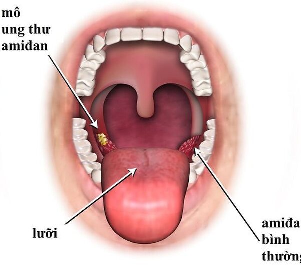 Ung thư amidan - triệu chứng không nên chủ quan