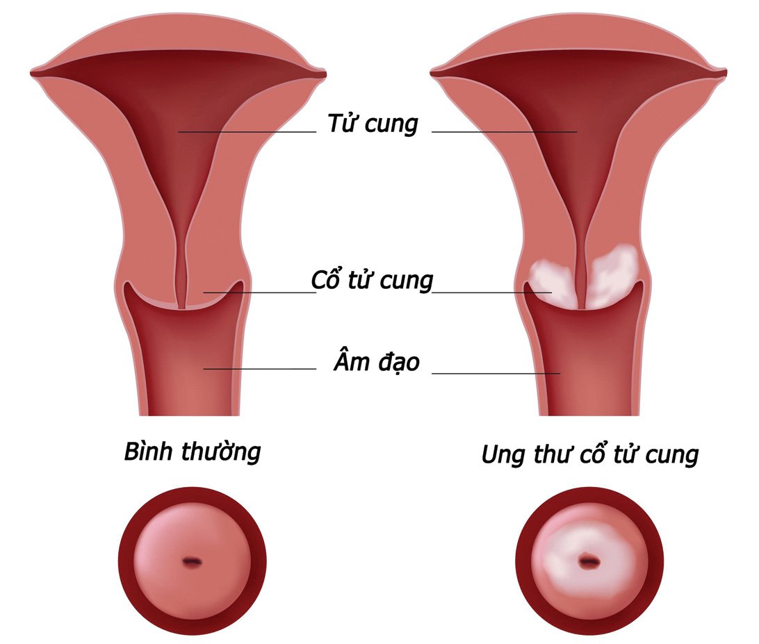 bệnh ung thư cổ tử cung