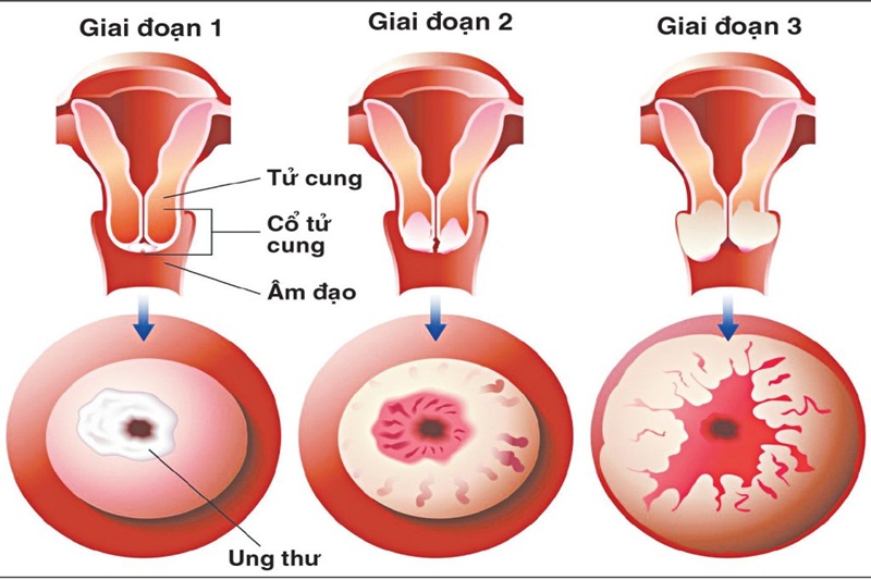 ung thư cổ tử cung giai đoạn 1