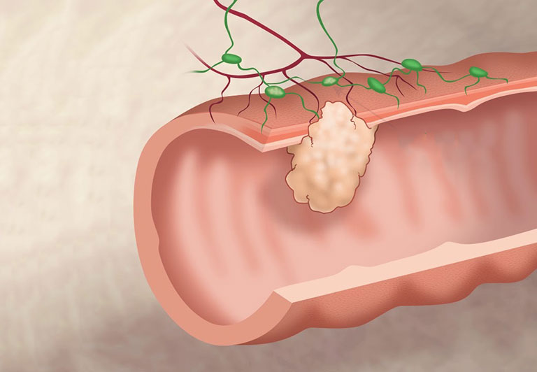 Hiểu rõ về ung thư đại tràng giai đoạn cuối