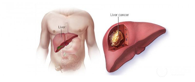 Ung thư gan giai đoạn đầu nên làm gì?