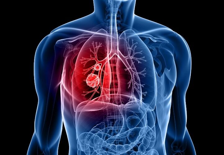 Tỷ lệ ung thư phổi ở Việt Nam ngày càng gia tăng