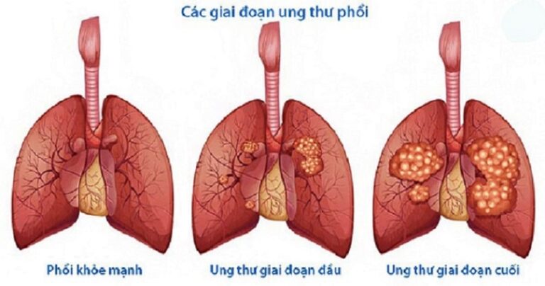 Ung thư phổi có mấy giai đoạn?