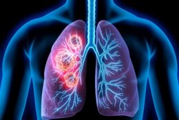 Ung thư phổi di căn - Dấu hiệu dấu chấm cuộc đời