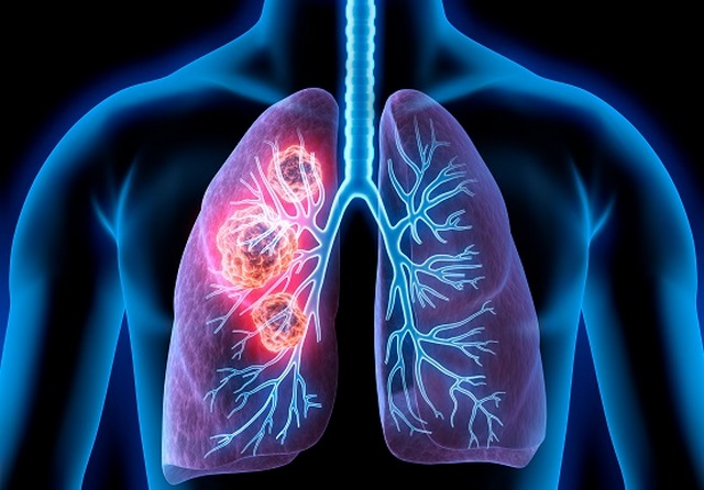 Mối lo sợ : ung thư phổi sống được bao lâu?