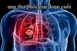 Ung thư phổi giai đoạn cuối có phải là giai đoạn nguy hiểm nhất không?