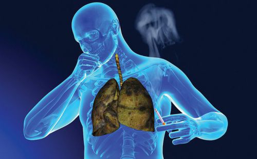 Ung thư phổi giai đoạn cuối có phải là giai đoạn nguy hiểm nhất không?