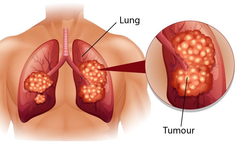 Ung thư phổi là căn bệnh nguy hiểm và đang ngày càng gia tăng
