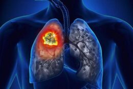 Phát hiện kịp thời ung thư phổi giai đoạn 3 không quá muộn