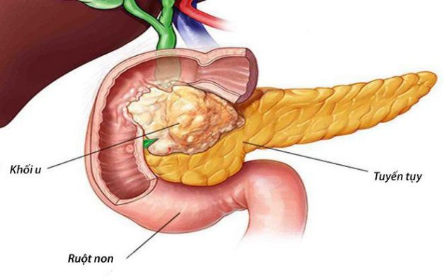 Bệnh lý ung thư tuyến tụy sống được bao lâu?