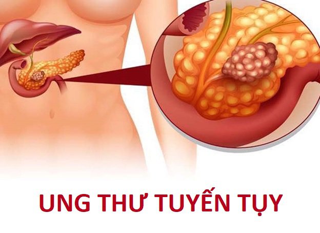 Bệnh lý ung thư tuyến tụy sống được bao lâu?