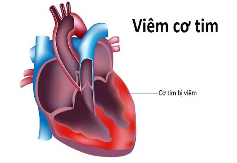 cảnh báo viêm cơ tim gây tử vong nhanh 