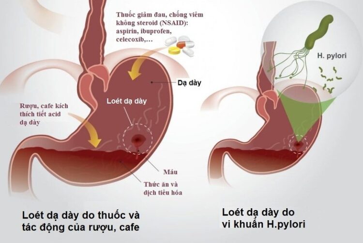 Sự bào mòn của viêm dạ dày tá tràng