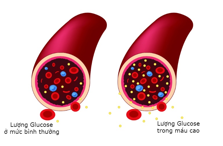 Tìm hiểu ăn nhiều đường bị bệnh gì?