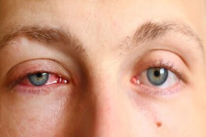 Đau mắt đỏ sưng húp có sao không? Các mẹo giúp giảm sưng húp bạn nên biết