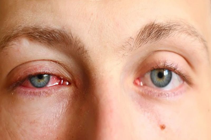 Các cách phòng tránh bệnh đau mắt đỏ hiệu quả không phải ai cũng nắm được