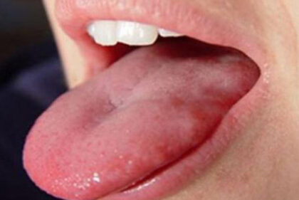bệnh nấm lưỡi