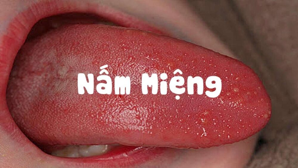 bệnh nấm lưỡi