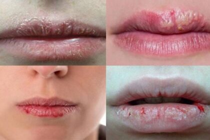 Bị chàm môi có gì nguy hiểm?
