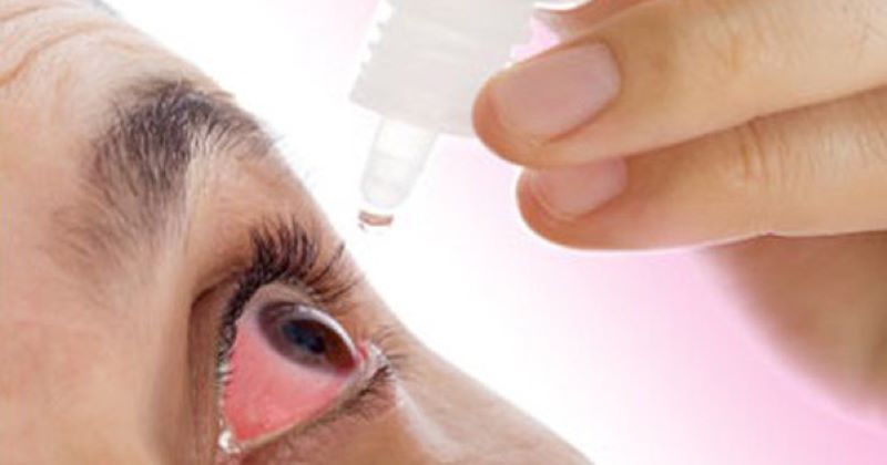 Bị đau mắt đỏ có cần phải ăn kiêng không? Phải lưu ý gì khi bị đau mắt đỏ