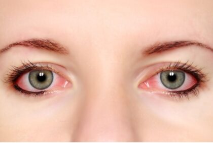 Bệnh đau mắt hột không nên chủ quan. Bệnh đau mắt hột nguy hiểm như thế nào?