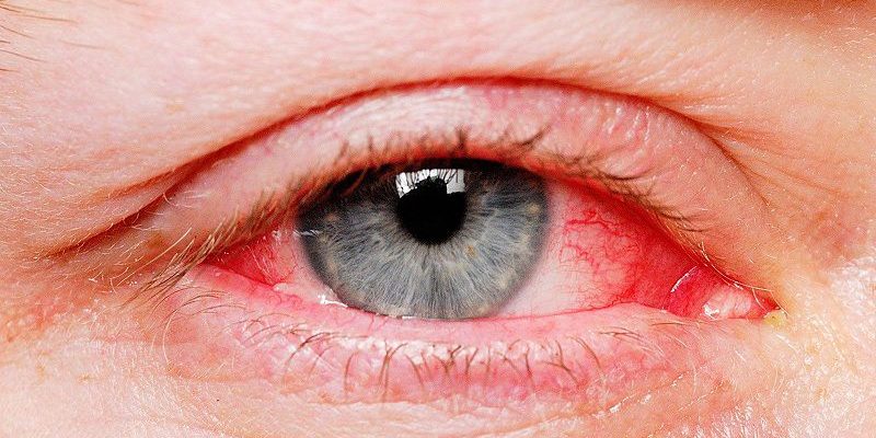Các cách phòng tránh bệnh đau mắt đỏ hiệu quả không phải ai cũng nắm được