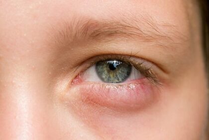 Bị mắt lẹo vì sao. Tìm hiểu thêm những thông tin cần thiết về bệnh mắt lẹo.