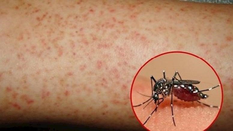 Dấu hiệu của các loại bệnh sốt rét và những lưu ý khi nhiễm bệnh này