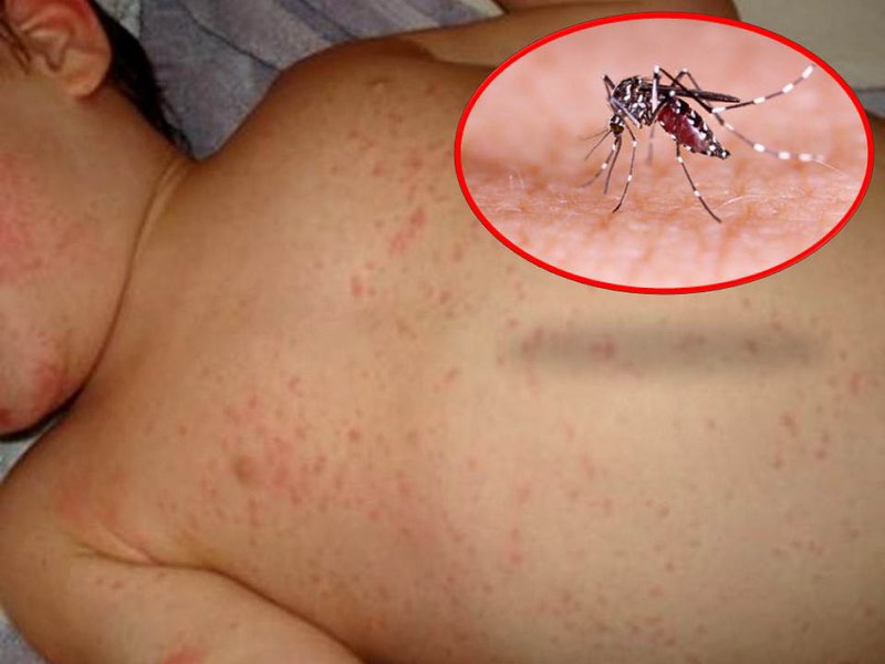 Các chuyên gia nói gì về sốt xuất huyết. Bạn cần lưu ý gì khi bị sốt xuất huyết?